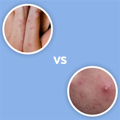 Bed Bug Bites VS Pimples– Bed Bug SOS