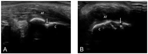 The Role of Clinical and Ultrasound Enthesitis Scores in Ankylosing ...