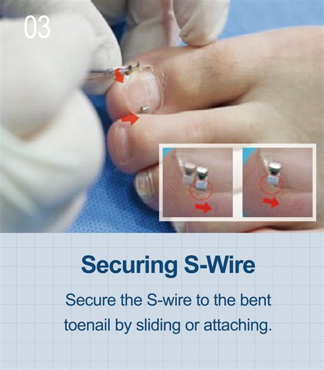 Onycho Clip - TERASYS (Domestic)