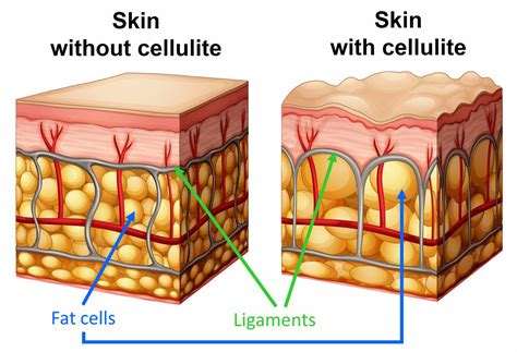 What Is Cellulite