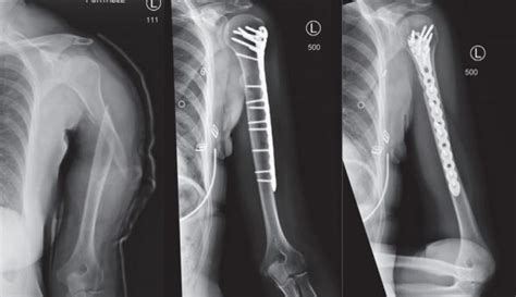 科学网—如何采用肱骨前外侧入路治疗上臂肱骨干中1/3段骨折？ - 高绪仁的博文