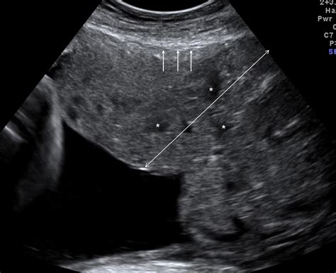 Placenta Accreta Spectrum - Obstetrics and Gynecology Clinics