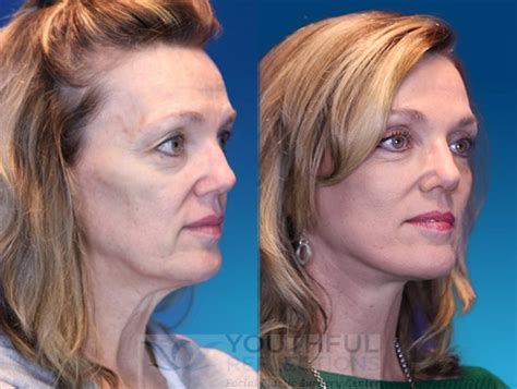CO2 Laser Skin Resurfacing Before & After Photos Patient 8 | Nashville, TN | Youthful Reflections
