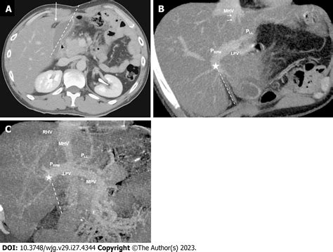 Predicting portal venous anomalies by left-sided gallbladder or right ...