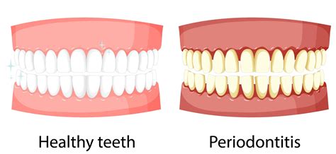 What is periodontal disease? Causes, symptoms, and everything – Laifen-CA