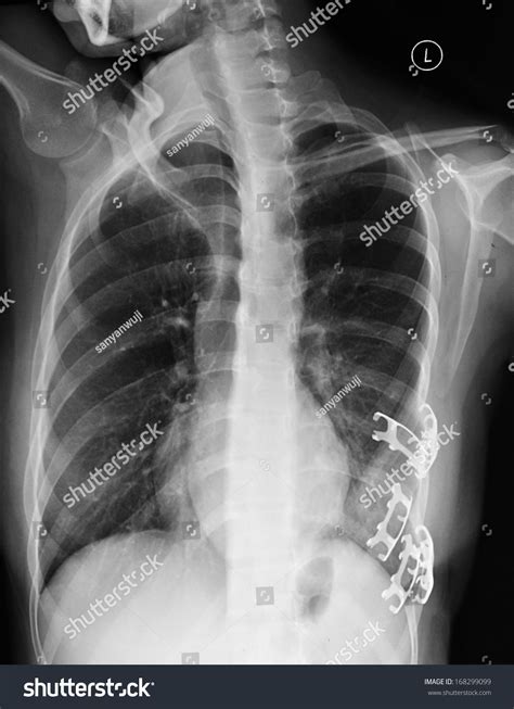 Best X Ray View For Anterior Rib Fracture