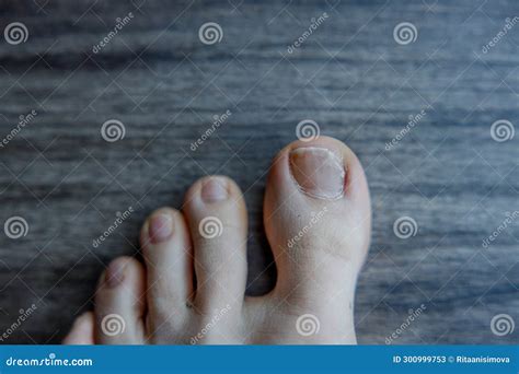 Killing Toenail Bed at Brenda Norris blog