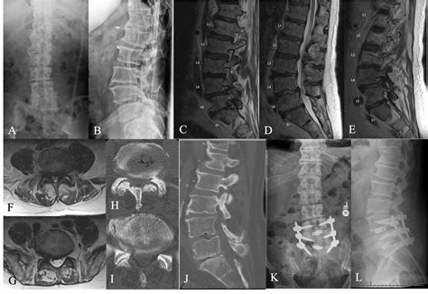 Spinal Fusion L5 S1 Recovery