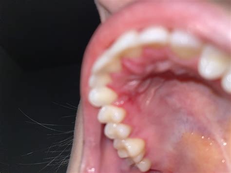 is that white spot on my gum a canker sore? if not, what could it be? : r/CankerSores