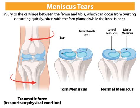 Knee Meniscus and ACL Surgery: What You Need to Know - AOSMI