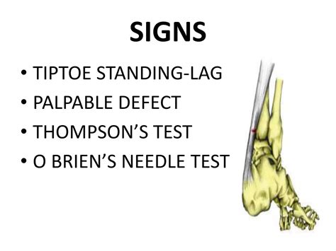 Tendo achilles injury | PPTX | Death, Injury, or Military Conflict | Sensitive Topics