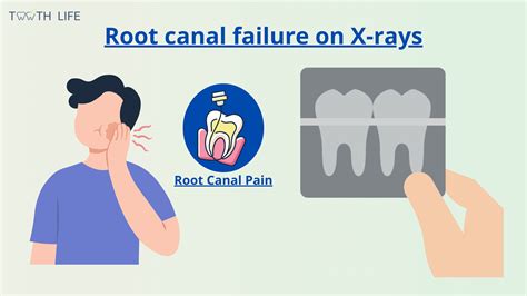 Tooth pain persisting even months after root canal treatment