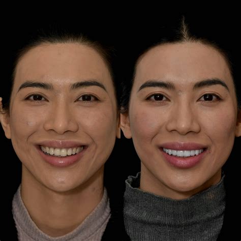 Gallery: Before and After Dental Veneers in Los Angeles, CA | Smiles By Dr. P