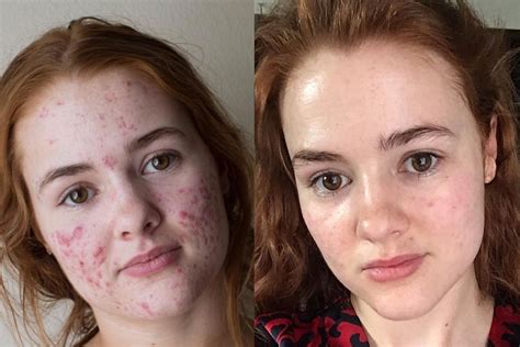 Review: Accutane For Acne - Usage, Side Effects & Before & After Picture