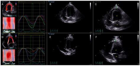 Speckle-Tracking Echocardiography in Dogs: Evaluating Imaging ...