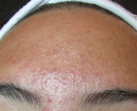 4 Different Skin Conditions That Are Often Considered As Acne | 4 ...