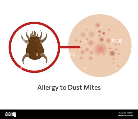 Skin allergy to dust mites vector illustration design Stock Vector Image & Art - Alamy
