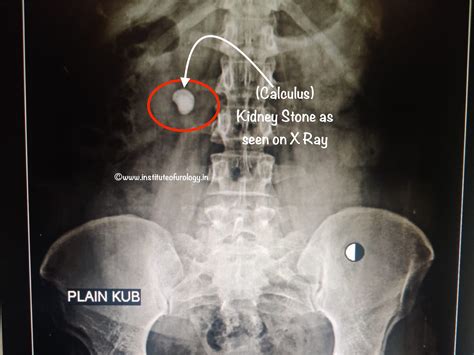 X Ray Showing Kidney Stones Kidney Stone ( Renal Stone , Renal Calculi