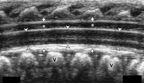 Cerebrospinal Fluid Leakage After Lumbar Puncture in Neonates ...