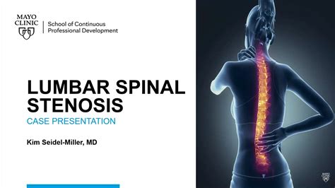 Classification Of Lumbar Fractures - Design Talk