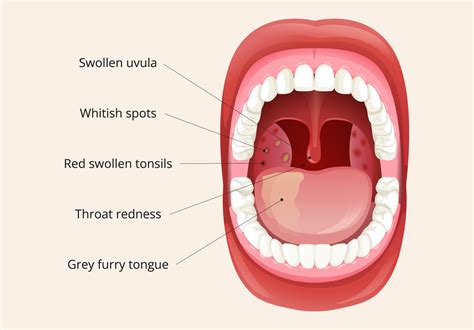Strep Throat White Spots On Tonsils