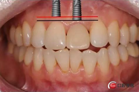 牙齿种植体十大排名，瑞士的、美国的、德国的...手把手教你选~-三元整形网