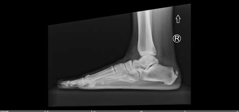 Insertional Achilles Calcific Tendonitis — Chicago Foot & Ankle ...