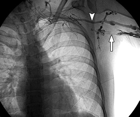 Power-Pulse Spray Thrombectomy for Treatment of Paget-Schroetter ...