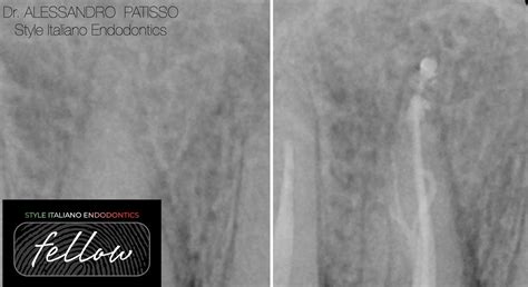Endodontics Marlborough Ma at Karen Medina blog