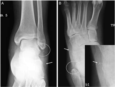 Osseous injuries of the foot: an imaging review. Part 3: the hindfoot ...