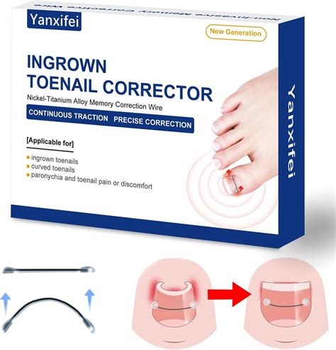 Amazon.com: Nitinol Ingrown Toenail Corrector,at Home Ingrown Toenail Treatment,Curved Toenail ...