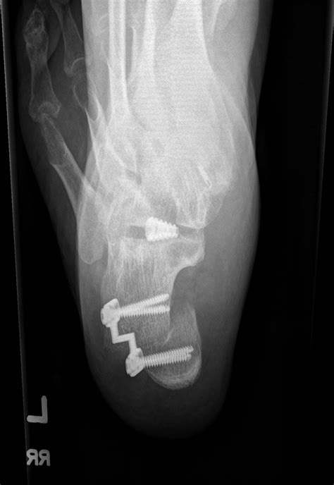 Medial Displacement Calcaneal Osteotomy: A Comparison of Screw Versus ...