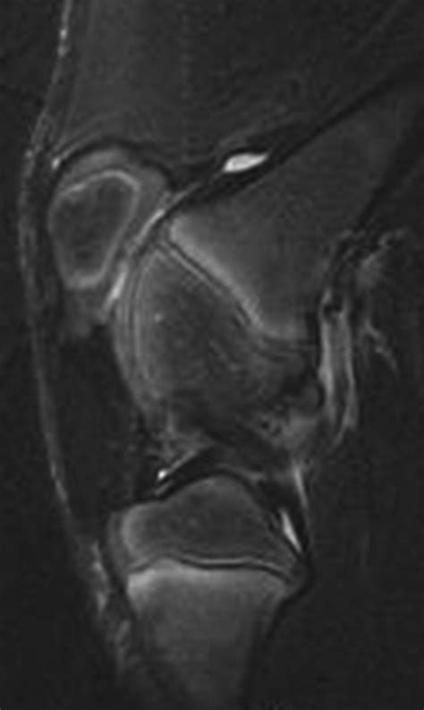 Bone Bruise Knee Mri