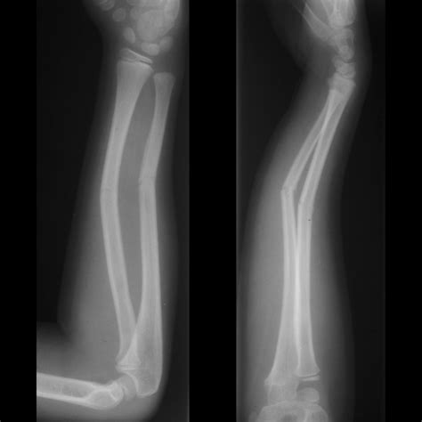 Greenstick Fracture