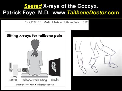 SEATED Coccyx X-rays Show Abnormalities Missed by Regular Standing X-rays, for Tailbone Pain ...