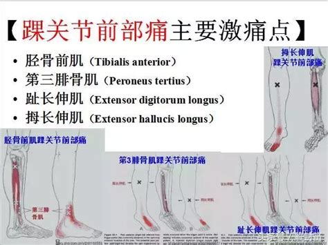 全身激痛点手册—图文并茂，理疗高手必备 - 每日头条