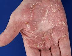 Image result for pustulosis