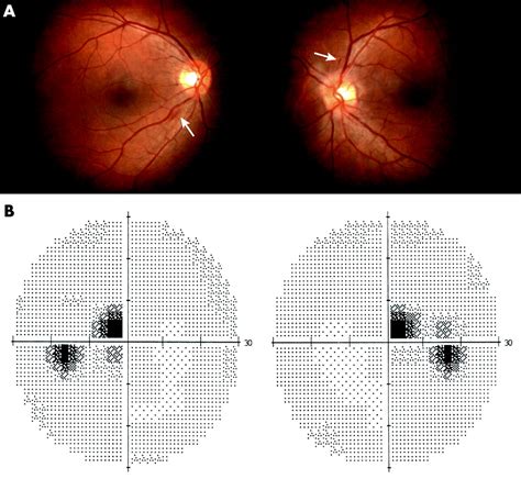 Ethambutol Toxicity Eye Screening Clipart