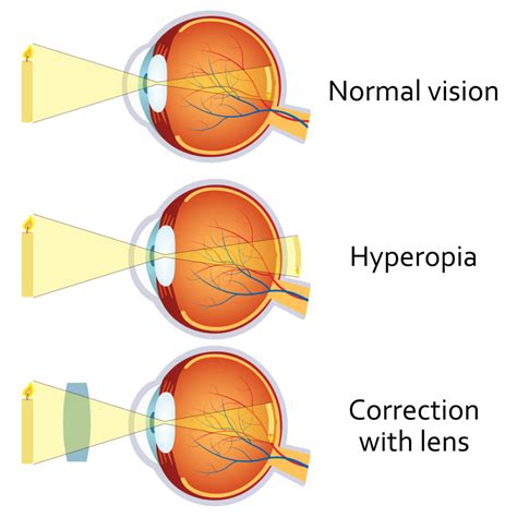 Understanding refraction and refractive errors – Eyewa Blog