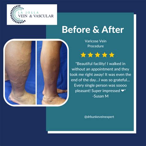 Vein & Vascular Treatment | Patient testimonials