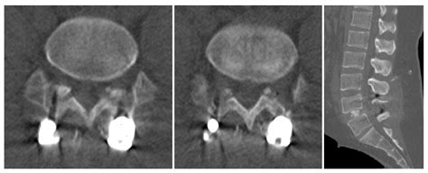 Recurrent Spinal Canal Stenosis after Decompression and Fusion Surgery ...