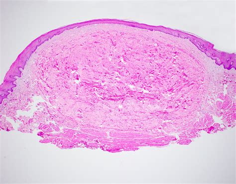 Irritation Fibroma Histology
