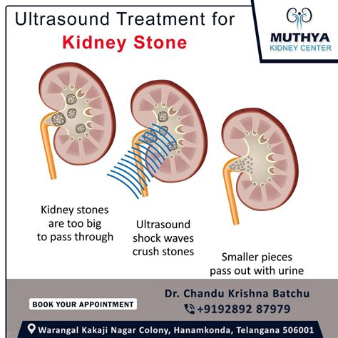 infection kidney stones