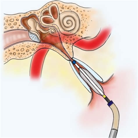 Eustachian Tube Balloon Dilation - Ear & Sinus Institute