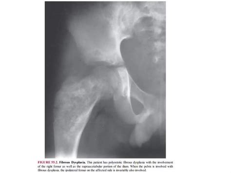 Lytic lesions of bone | PPTX