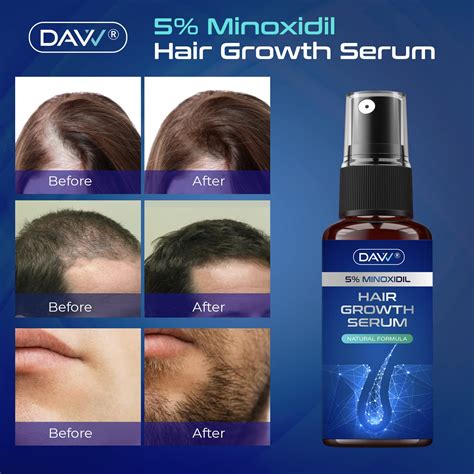 Buy Minoxidil For Hair Loss – Minoxidil Hair Growth Topical Solution 5% – IXXLIQ