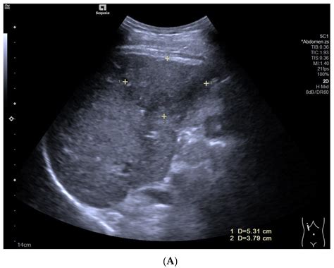 Imaging Features of Hepatocellular Carcinoma in the Non-Cirrhotic Liver with Sonazoid-Enhanced ...