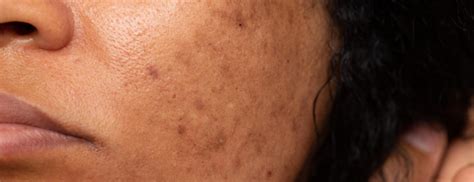 Skin Disease Treatment | Skincare Clinic in Trichy | Mithran Health Care