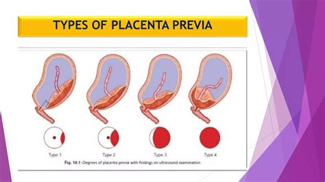 Placenta previa | PPTX