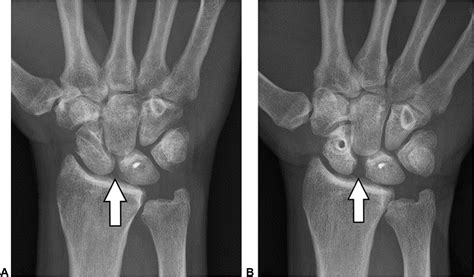 Scapholunate Ligament Injuries - Journal of Hand Surgery Global Online